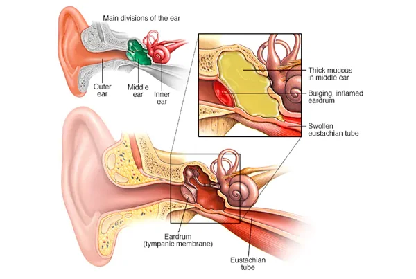 Ear Infections