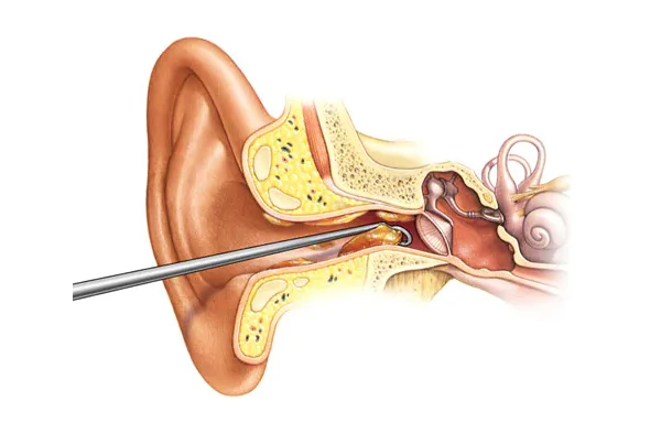 Ear Wax