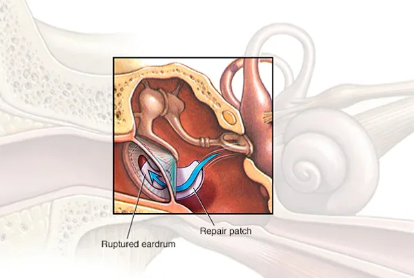 Eardrum Repair