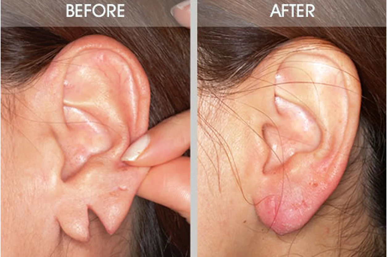 Ear Lobe Repairing