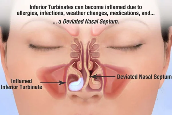 Nasal Septum Surgery