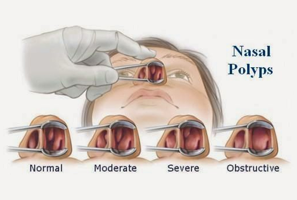 Nasal Polyps