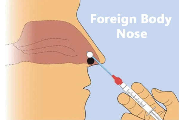 Foreign Body Removal Nose