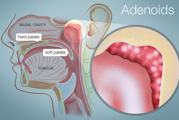 Adenoid Surgery
