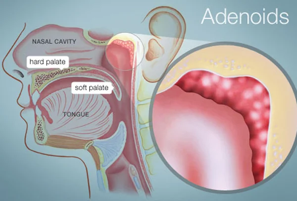Adenoid Surgery