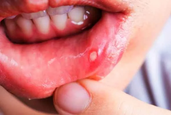 Oral Ulcers