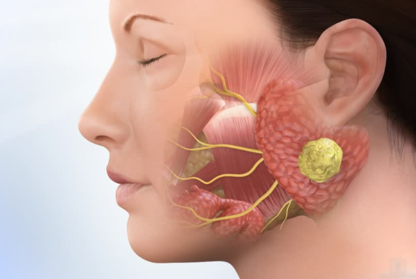 Salivary Gland Problems